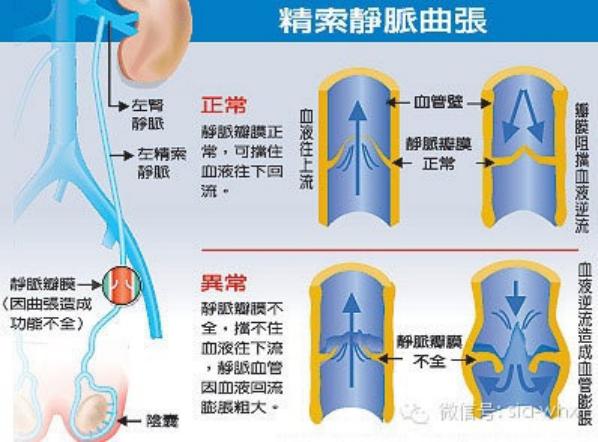 關(guān)于2021年征兵精索靜脈曲張標準的探討，2021年征兵精索靜脈曲張標準深度解析